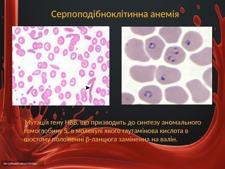 Серпоподібноклітинна анемія Мутація гену HBB, що призводить до синтезу аномального гемоглобину S, в молекулі