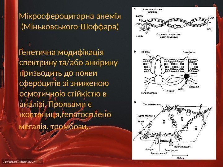 Мікросфероцитарна анемія (Міньковського-Шоффара) Генетична модифікація спектрину та/або анкірину призводить до появи сфероцитів зі зниженою