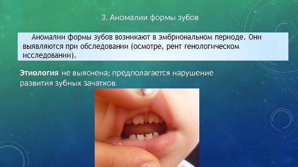 3. Аномалии формы зубов Этиология не выяснена; предполагается нарушение развития зубных зачатков. 