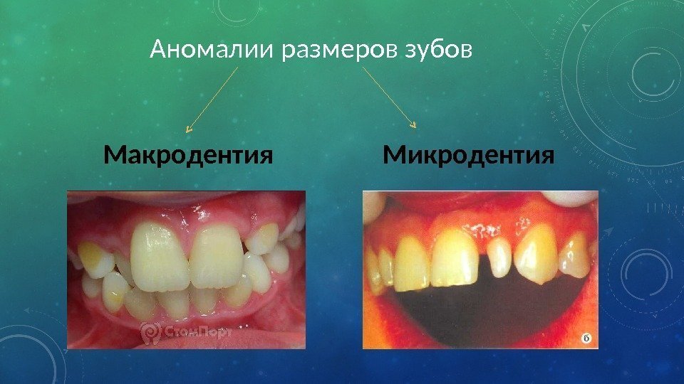 Аномалии размеров зубов Макродентия   Микродентия 
