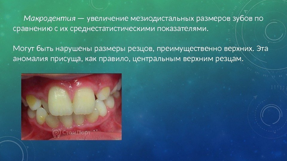 Макродентия — увеличение мезиодистальных размеров зубов по сравнению с их среднестатистическими показателями.  Могут
