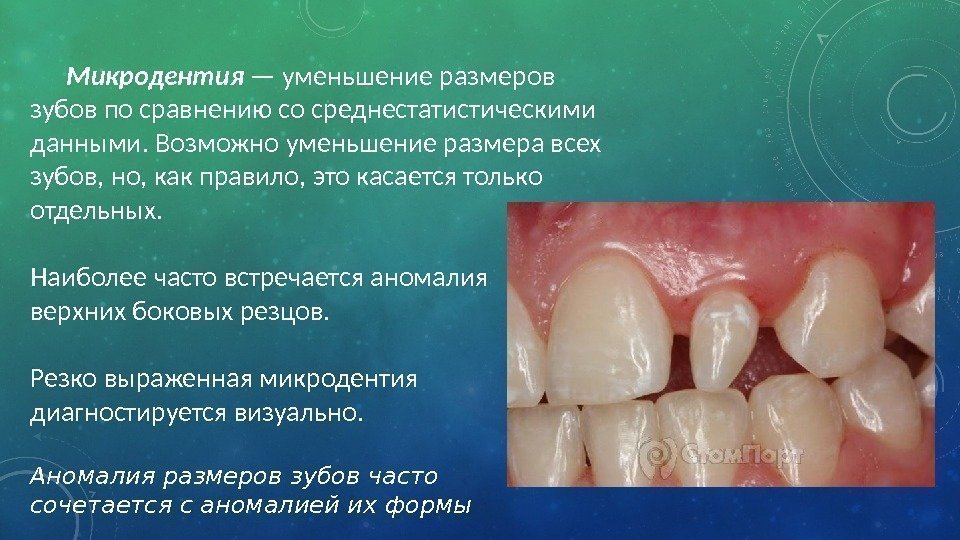 Микродентия — уменьшение размеров зубов по сравнению со среднестатистическими данными. Возможно уменьшение размера всех