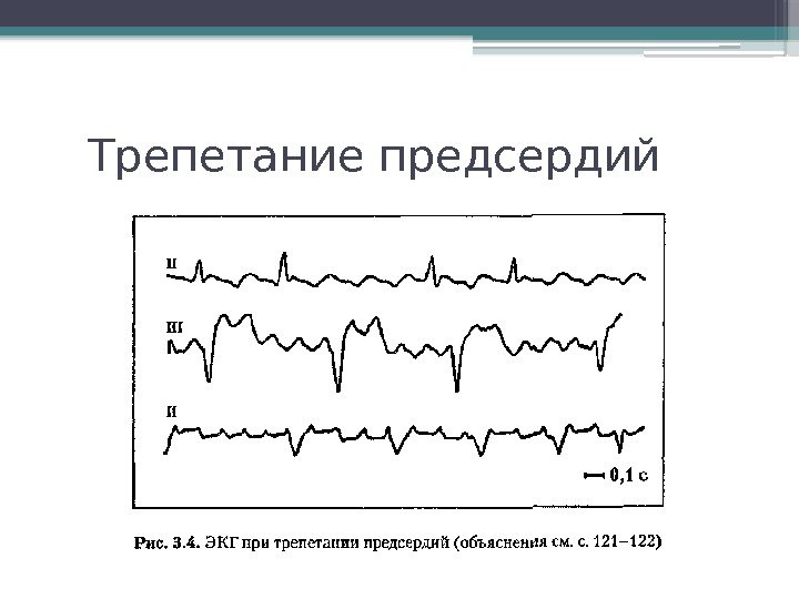 Трепетание предсердий карта вызова