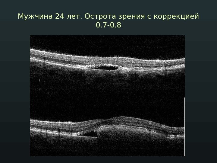 Мужчина 24 лет. Острота зрения с коррекцией 0. 7 -0. 8 