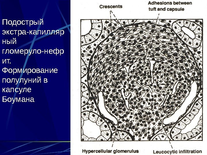 16 Подострый экстра-капилляр ный гломеруло-нефр ит.  Формирование полулуний в капсуле Боумана 