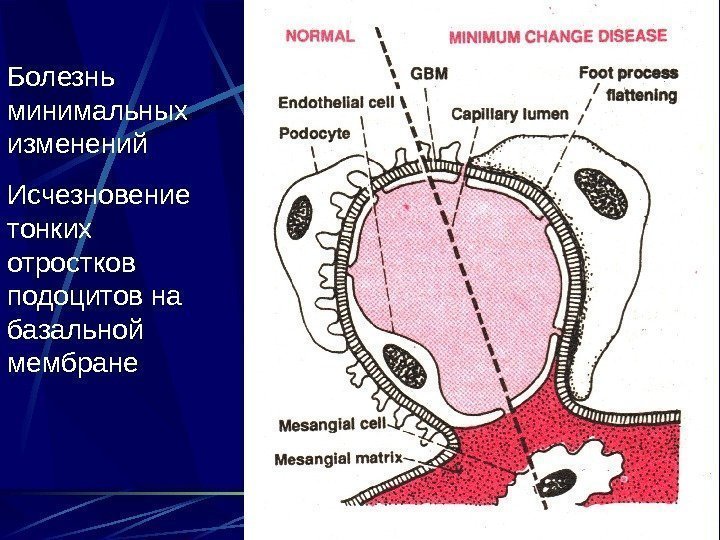 20 Болезнь минимальных изменений Исчезновение тонких отростков подоцитов на базальной мембране 