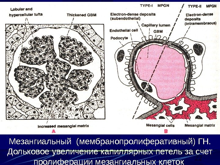 22 Мезангиальный (мембранопролиферативный) ГН.  Дольковое увеличение капиллярных петель за счет пролиферации мезангиальных клеток