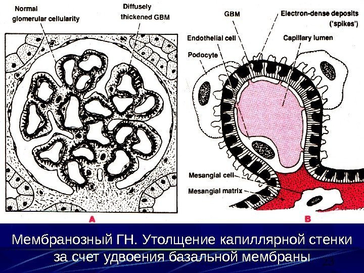 23 Мембранозный ГН. Утолщение капиллярной стенки за счет удвоения базальной мембраны 
