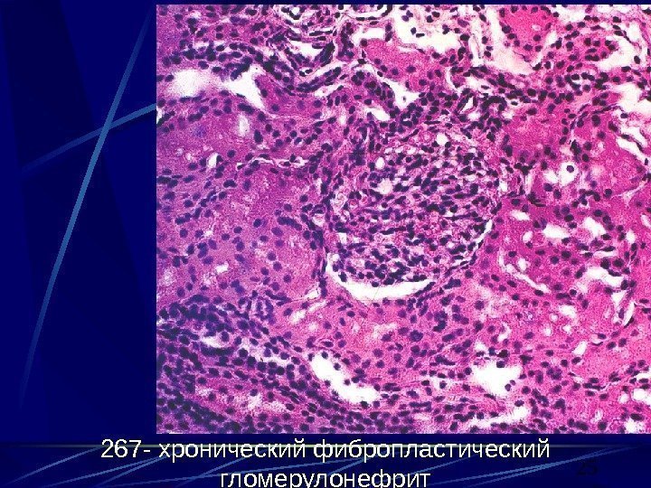 25267 - хронический фибропластический гломерулонефрит 