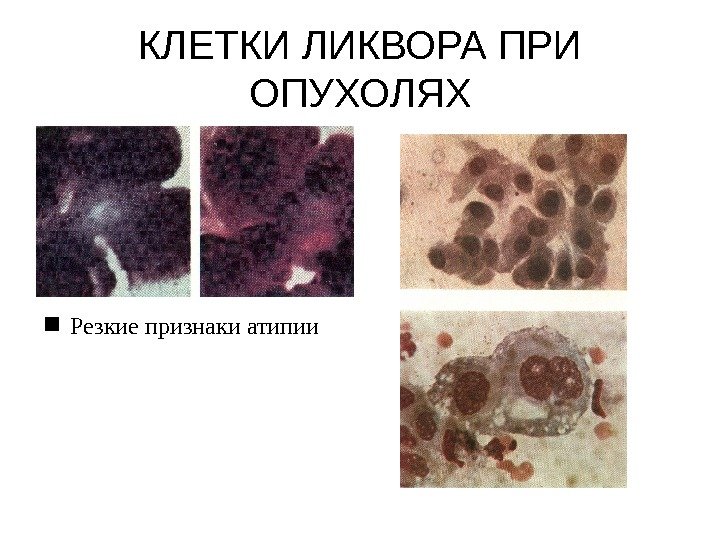 В картине ликвора при отогенном менингите