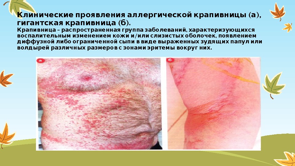   ( ), Клинические проявления аллергической крапивницы а  ( ). гигантская крапивница