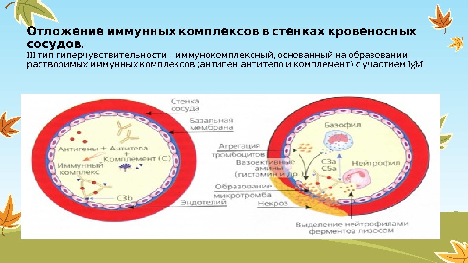   Отложение иммунных комплексов в стенках кровеносных. сосудов III – ,  