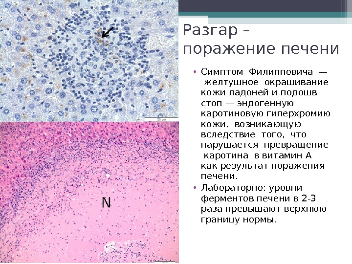 Разгар – поражение печени • Симптом Филипповича —  желтушное окрашивание кожи ладоней и