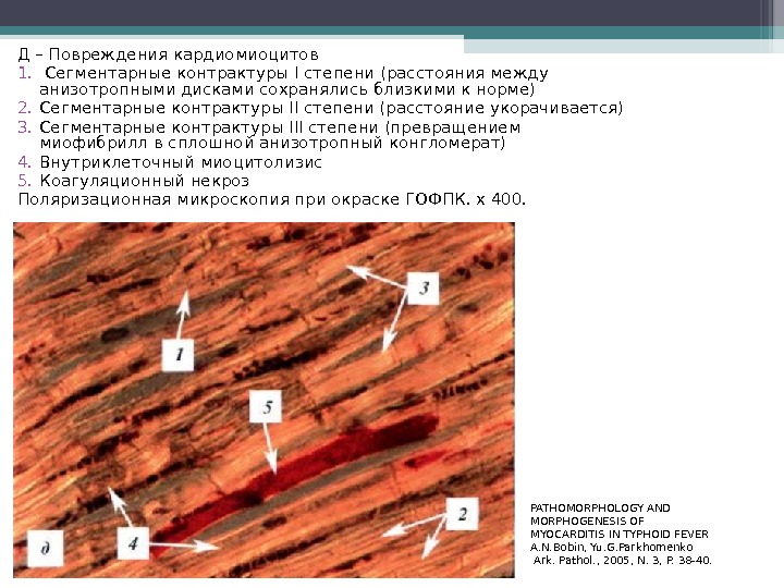 Д – Повреждения кардиомиоцитов 1.  Сегментарные контрактуры I степени (расстояния между анизотропными дисками