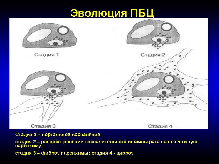 Эволюция ПБЦ Стадия 1 – портальное воспаление;  стадия 2 – распространение воспалительного инфильтрата