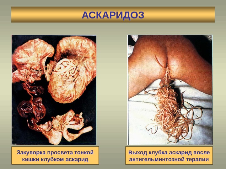 АСКАРИДОЗ Закупорка просвета тонкой кишки клубком аскарид Выход клубка аскарид после антигельминтозной терапии 