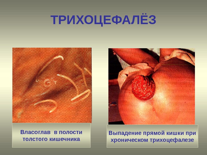 ТРИХОЦЕФАЛЁЗ Власоглав в полости толстого кишечника Выпадение прямой кишки при хроническом трихоцефалезе 
