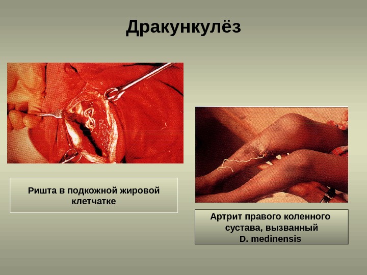 Дракункулёз Ришта в подкожной жировой клетчатке Артрит правого коленного сустава, вызванный D. medinensis 