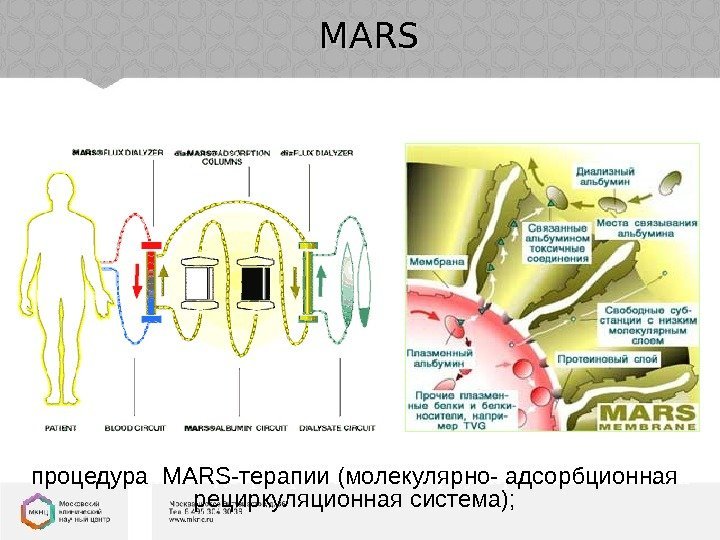 MARS Молекулярная Адсорбирующая Рециркулирующая Система процедура  MARS -терапии (молекулярно- адсорбционная  рециркуляционная система);
