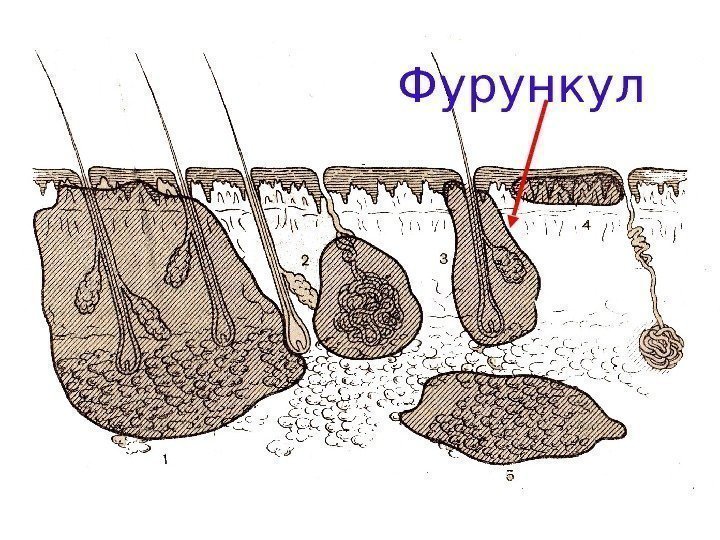   фурункул Фурункул 