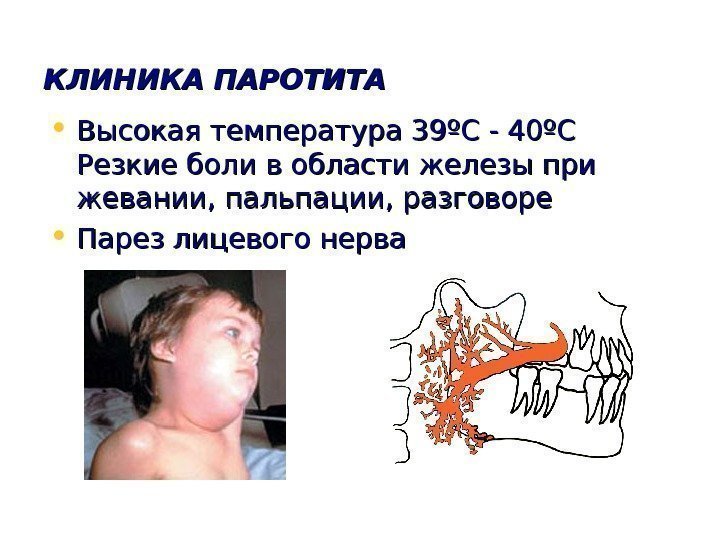   КЛИНИКА ПАРОТИТА • Высокая температура 39 ºº СС - 40 ºº СС