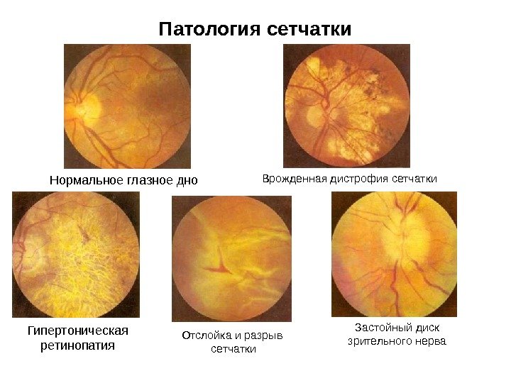 Патология сетчатки Нормальное глазное дно Гипертоническая ретинопатия Врожденная дистрофия сетчатки Отслойка и разрыв 
