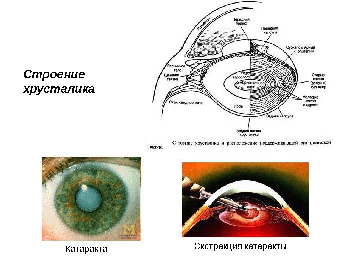 Строение хрусталика Катаракта Экстракция катаракты 